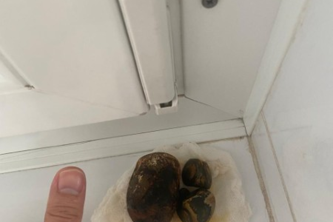 Көпбейінді қалалық жедел медициналық жәрдем ауруханасының дәрігерлері өт қабынан үлкен тас алды